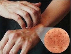 Gecikmiş gıda alerjileri ise Ig G immunoglobulinlerle ortaya çıkar Gıda tüketildikten 3 gün sonra dahi ortaya çıkabilir ifadelerini kullandı