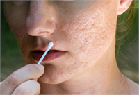 Sivilcelerinizi yok eder Biçimsiz sivilcelerden kurtulmanızı sağlar İçindeki antioksidanlar sayesinde bakterileri öldürür Dilimlenmiş sarımsak dişlerini sivilcelerinizin üzerine sürün